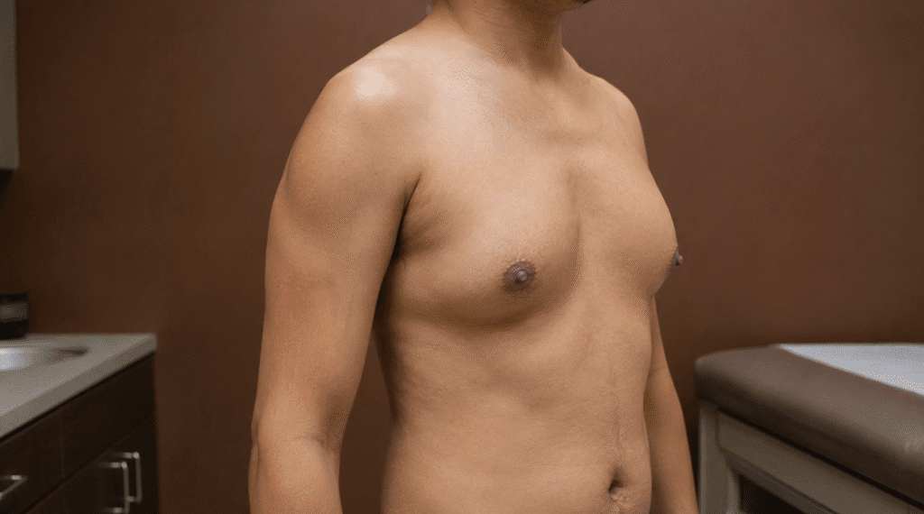 Is Gynecomastia Surgery Safe? Risks, Benefits & Results