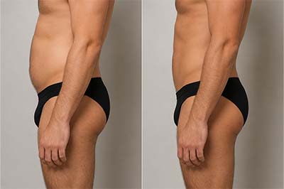 VASER liposuction results in Thane.