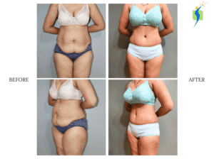 Tummy Tuck Before and After Results Tummy tuck before after results