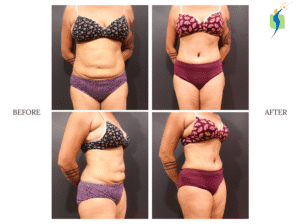 Tummy tuck before after results
