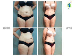 Tummy tuck before after results