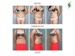 Bariatric Surgery Before and After Results  