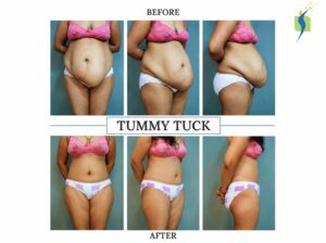 Bariatric Surgery Before and After Results 
