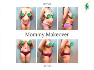 Bariatric Surgery Before and After Results 
