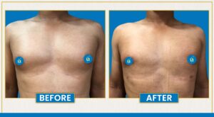 Male breast reduction surgery for gynecomastia