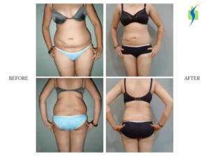  VASER liposuction before and after results for abdominal fat contouring 