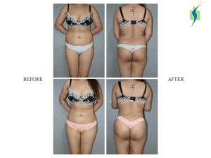 VASER liposuction before and after abdominal contouring VASER liposuction before and after results for abdominal fat contouring