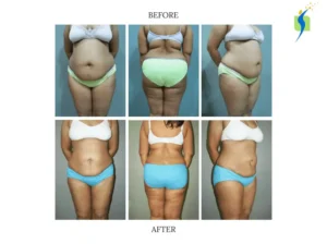  VASER liposuction before and after results for abdominal fat contouring 